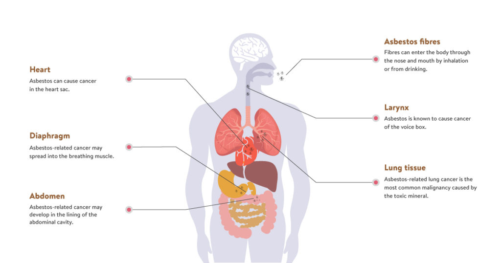 Asbestos Fibres Effect Human Body