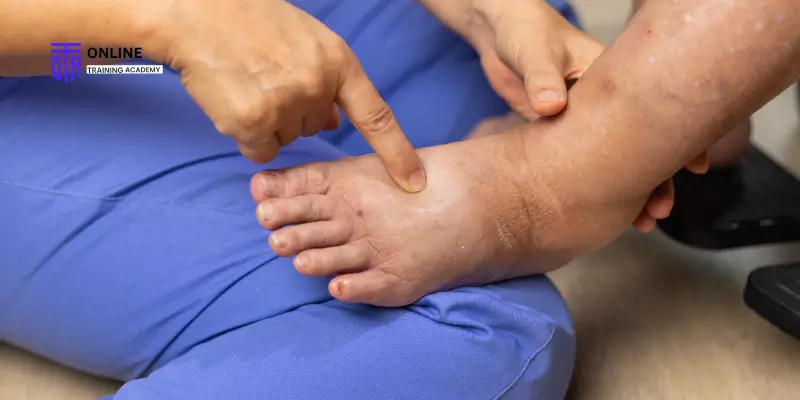 Long-Term Lymphedema Management_